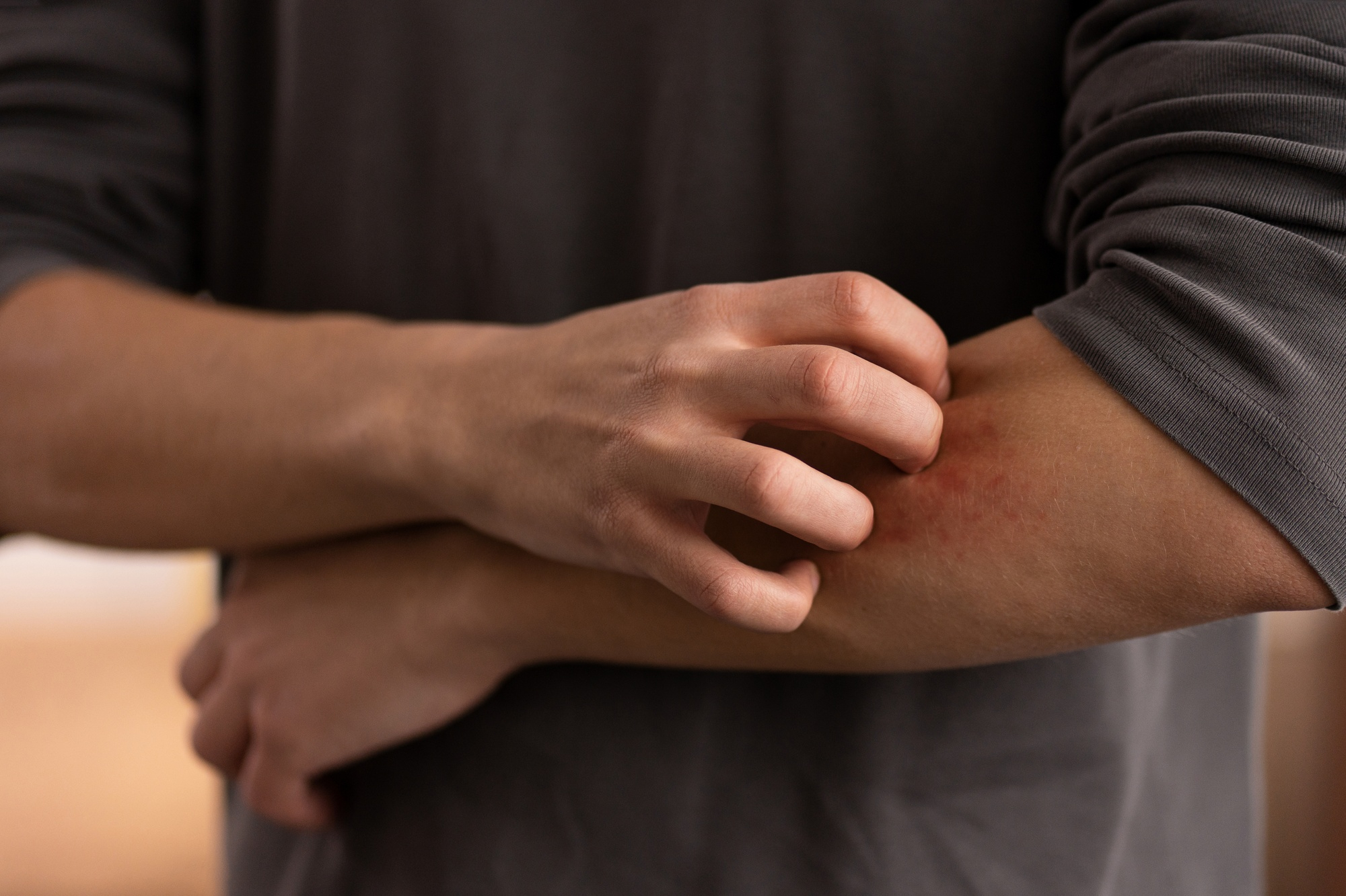 Alergia i AZS – Jak dieta łagodzi swędzenie skóry?